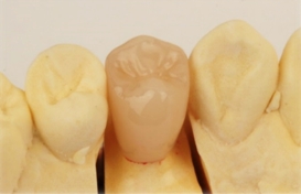 保険適用 CAD/CAM冠